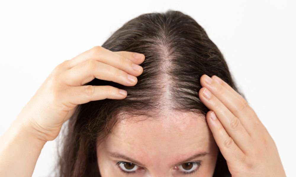 What is Traction Alopecia?