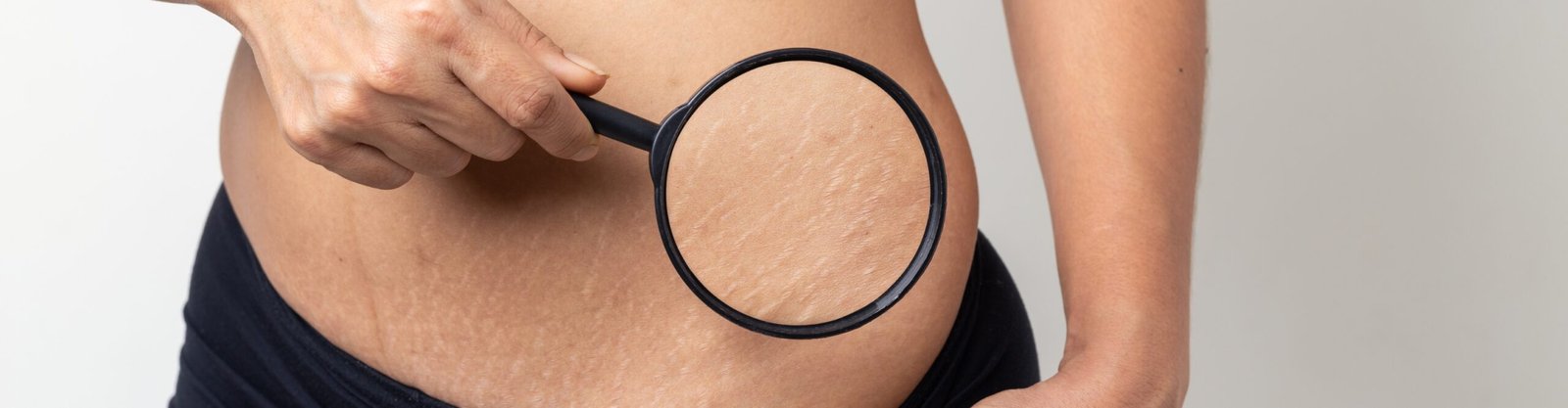 Stretch Marks