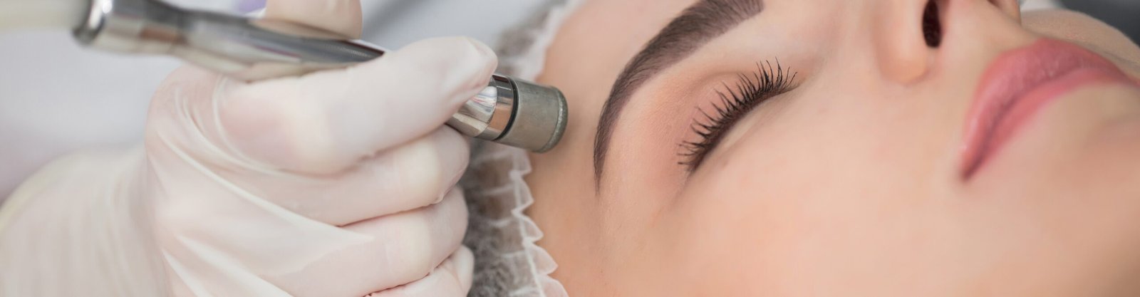 Microdermabrasion
