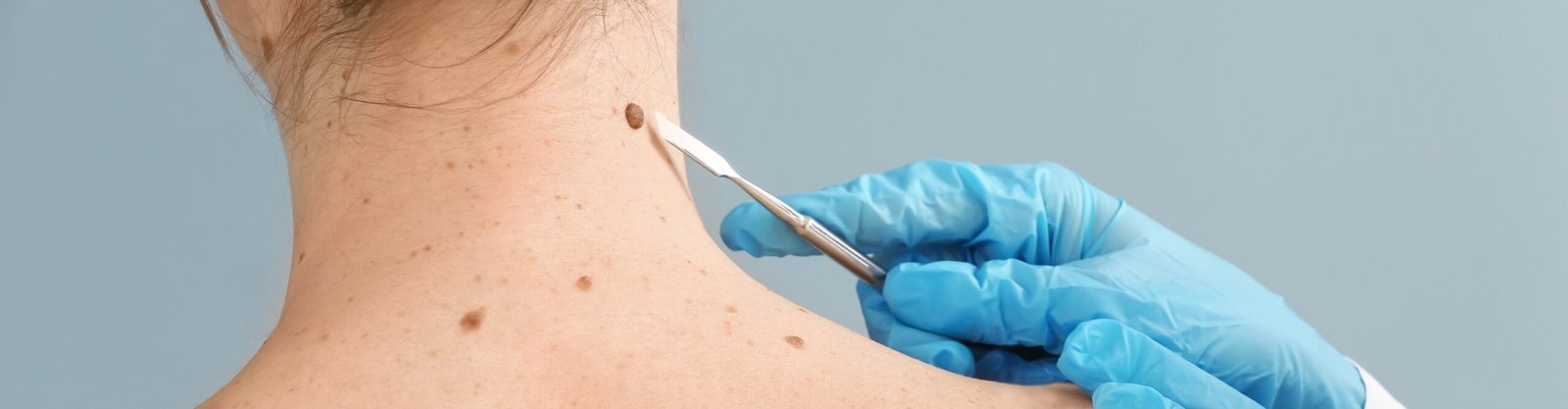 Skin Tag Removal