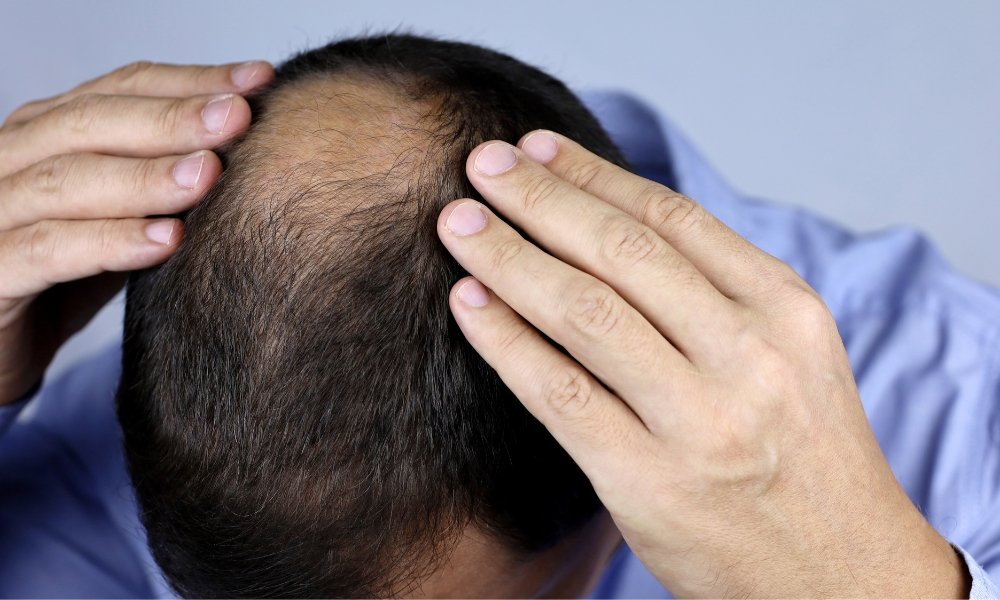 Male & Female Pattern Hair Loss (Androgenic Alopecia)