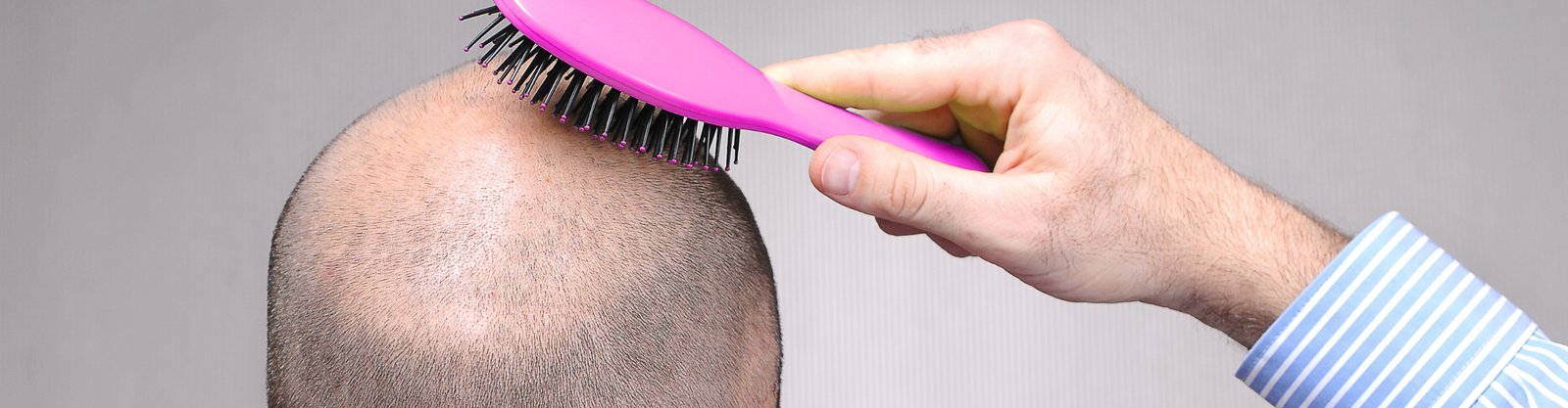 Male & Female Pattern Hair Loss (Androgenic Alopecia)