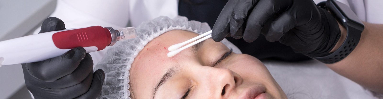 Laser & Skin Treatment Results at Derma Capital