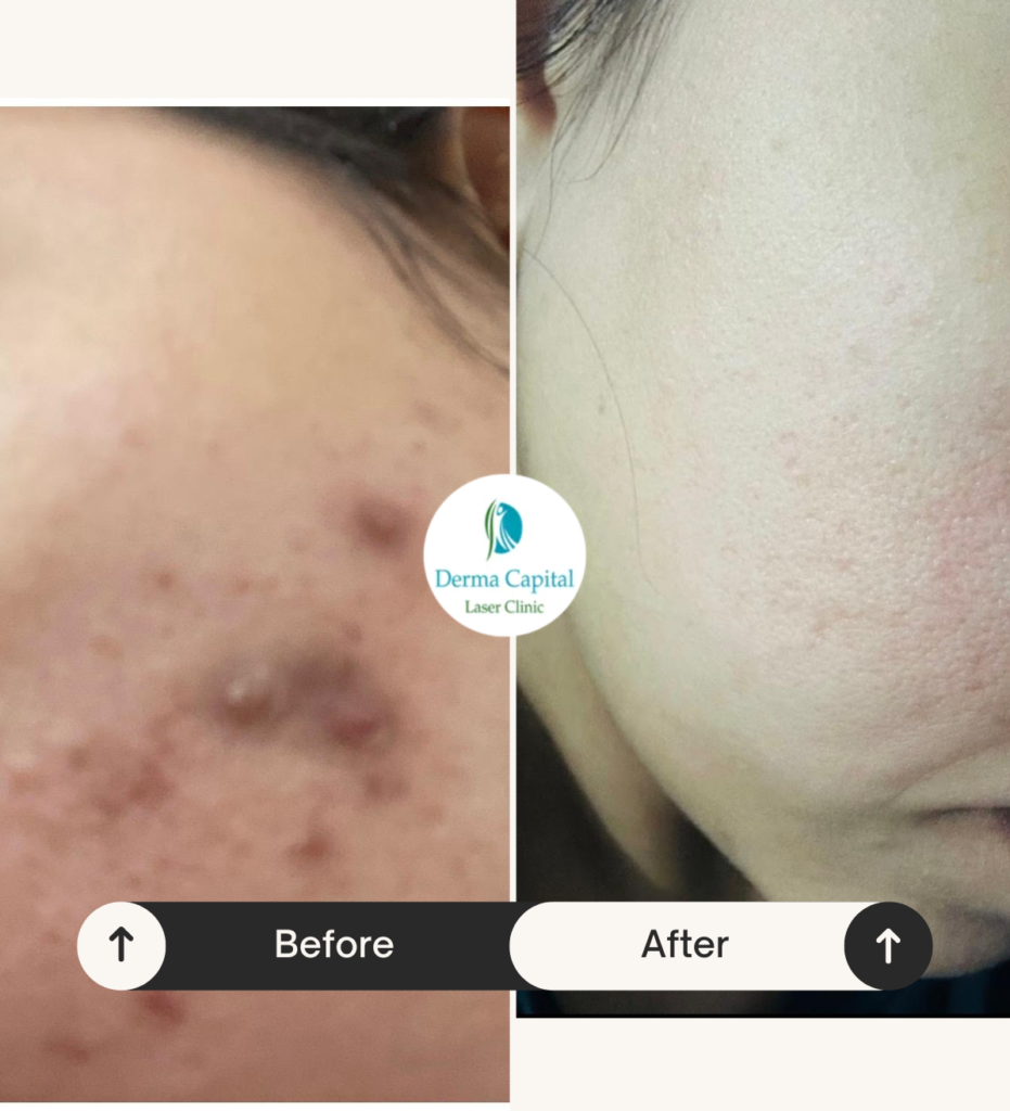 acne scar treatment before and after results in Brampton