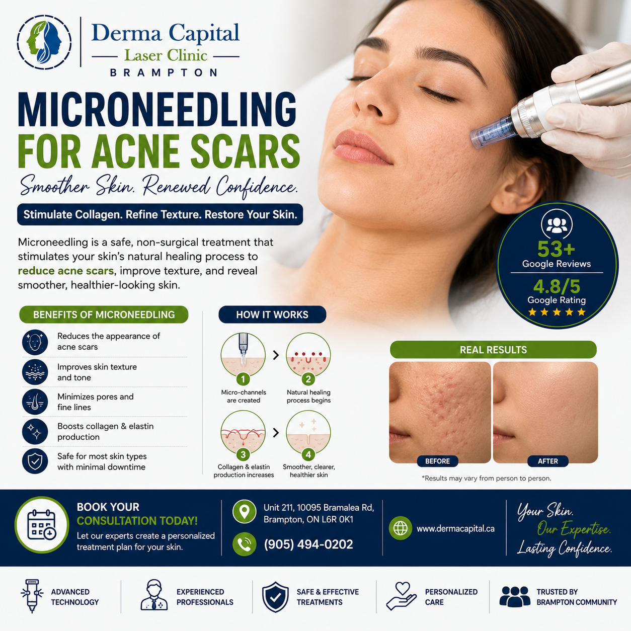 Microneedling for Acne Scars in Brampton: Benefits, Results & Recovery