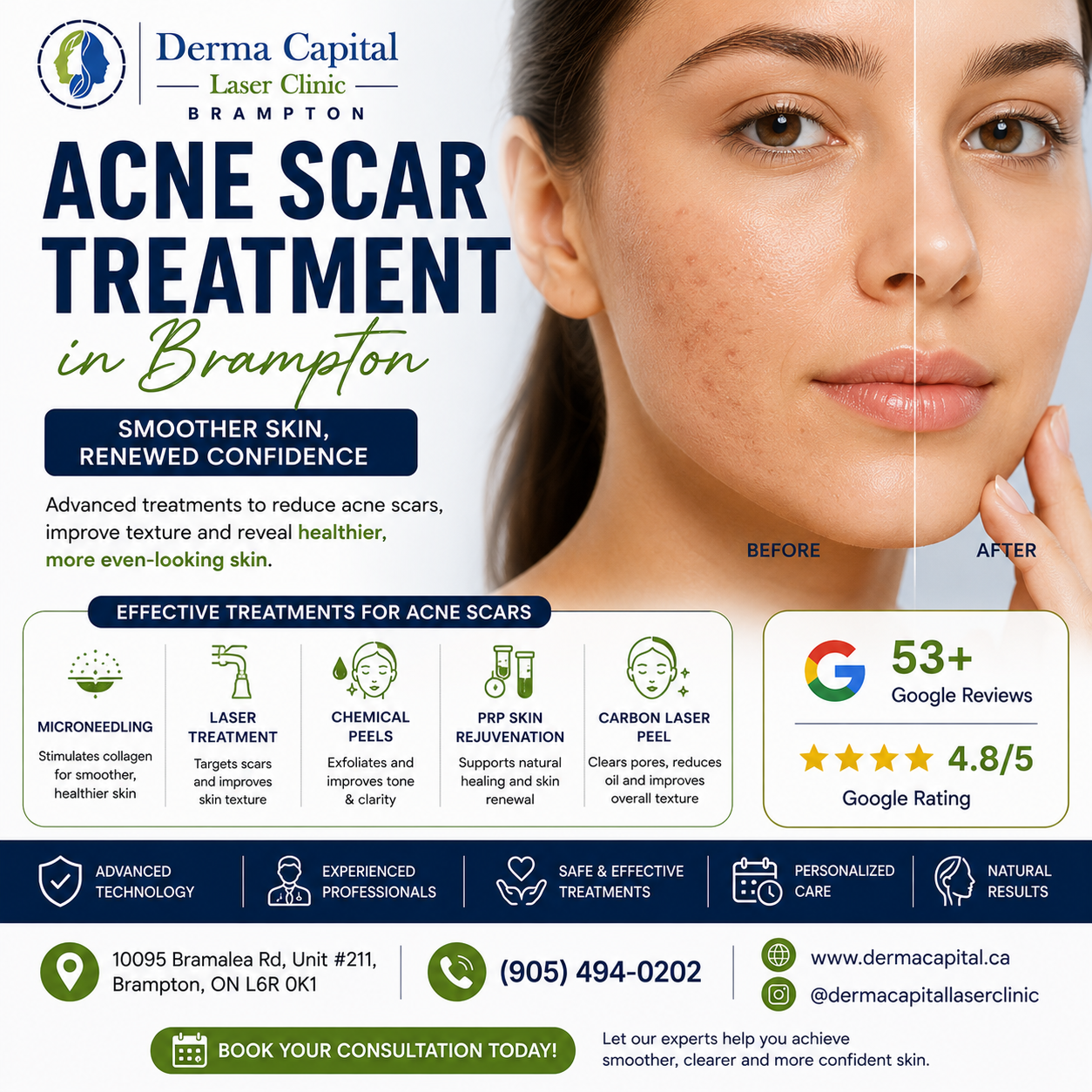 Acne Scar Treatment in Brampton: Best Options for Smoother Skin