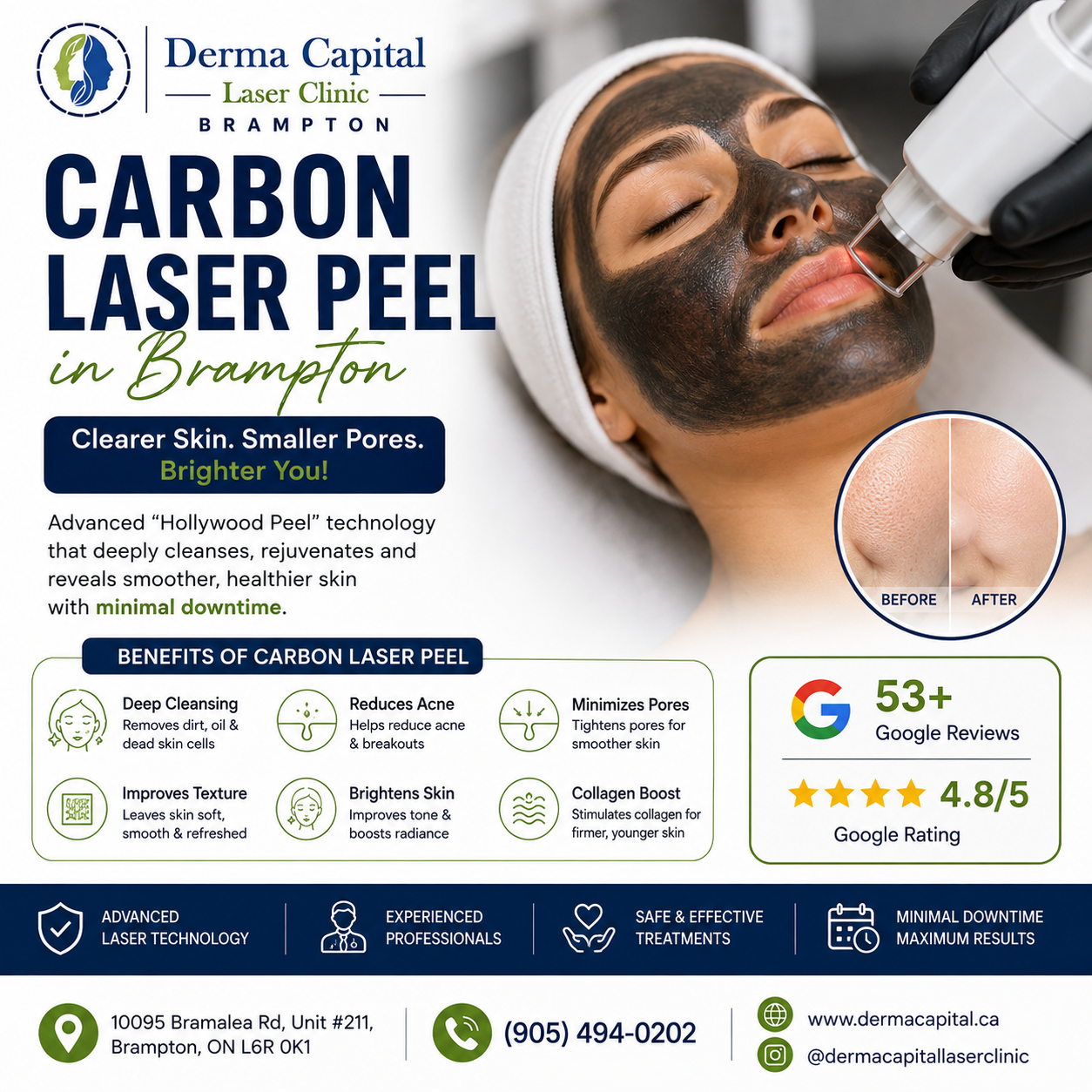 Carbon Laser Peel in Brampton: Benefits, Procedure & Results